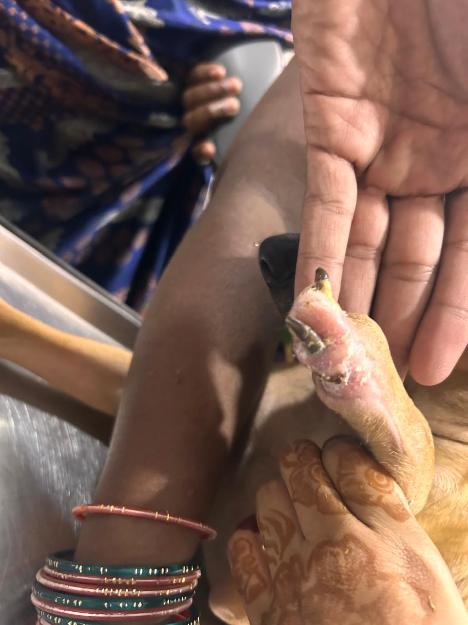 Hair Transplant After